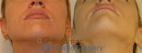 Nonsurgical Jaw Reduction With Botox Cosmetic To Sculpt The Face And