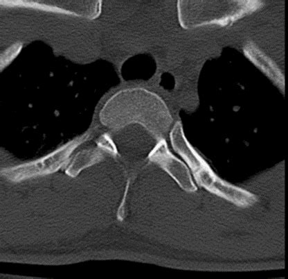 Thoracic Chest Imaging Flashcards Quizlet