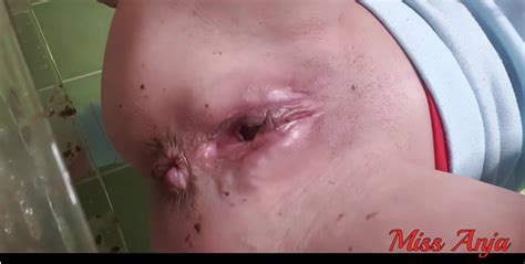 Blonde Girl Having Liquid Brown Diarrhea From Laxatives ThisVid