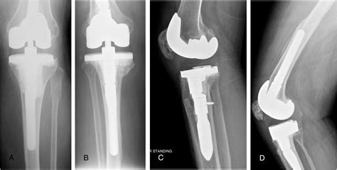 Intra Operative Periprosthetic Fractures Associated With Press Fit