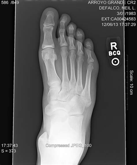 pseudo-jones right fifth metatarsal fracture needs surgery?