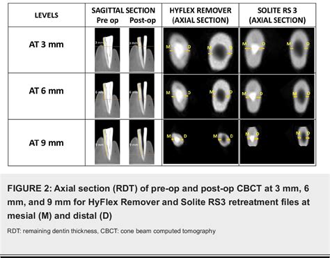 Figure From Comparative Evaluation Of Solite Rs And Hyflex Remover