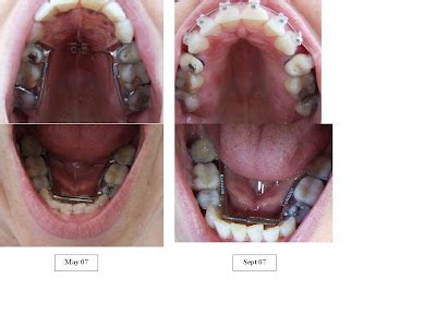 BraceFace Mom: Before and After Photos of Expander