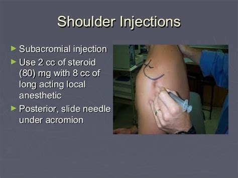 Subacromial Injection Landmarks