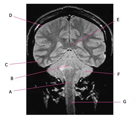 Sectional Anatomy Brain Pt 5 Diagram Quizlet