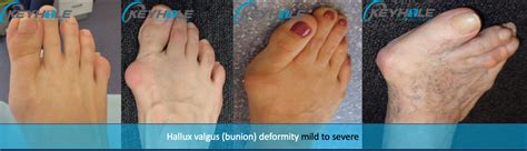 Mild Tailors Bunion