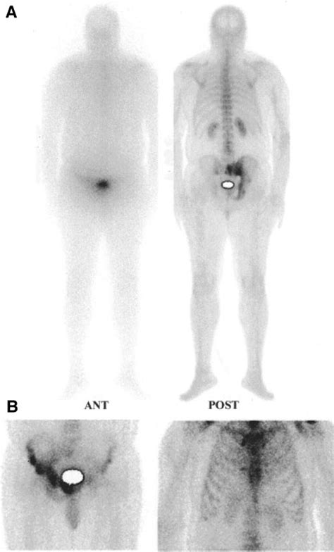 A 99m Tc Hmdp Anterior Ant And Posterior Post Total Body Bone