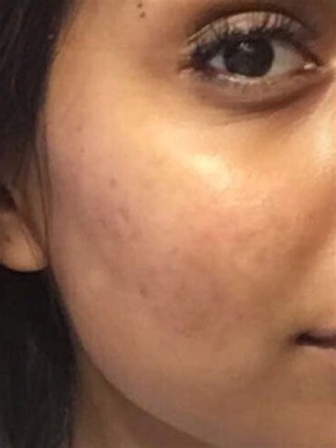 Controversial Cystic Acne Routine Goes Viral — Before-and-After Photos | Allure