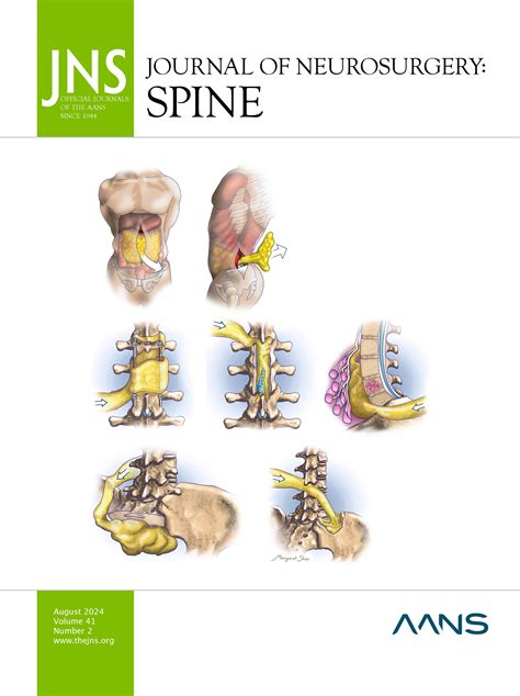 Comparison Of Transforaminal And Posterior Lumbar Interbody Fusion Outcomes In Patients