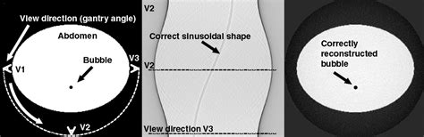 Gas Bubble Motion Artifact In Mdct Ajr