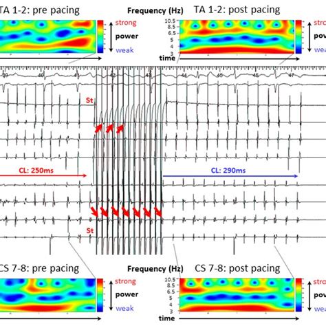 Case 1 Burst Pacing Was Attempted From The Right Atrial Appendage And Download Scientific