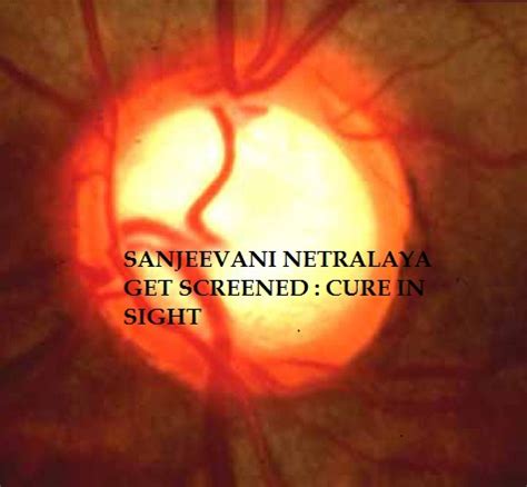 World Glaucoma Week GLAUCOMA SCREENING CAMP CURE IN SIGHT