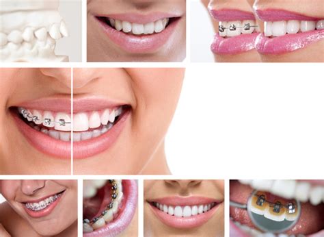 Invisalign Orthodontic Treatment Calgary And Alberta