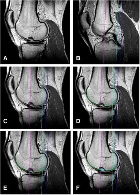 Segmentation Of The Mri A Sagittal Mri With Lateral Femoral Notch