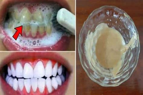 7 Astuces Pour Blanchir Ses Dents Naturellement