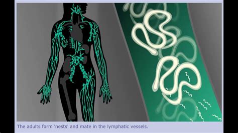 Lymphatic Filariasis Elephantiasis Life Cycle Youtube