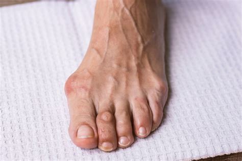 Treating Tailors Bunion In Frisco Frisco Foot And Ankle Specialists