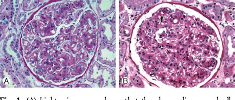 Membranoproliferative Glomerulonephritis Type 1