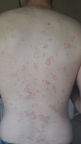 Ringworm Symptoms Rash