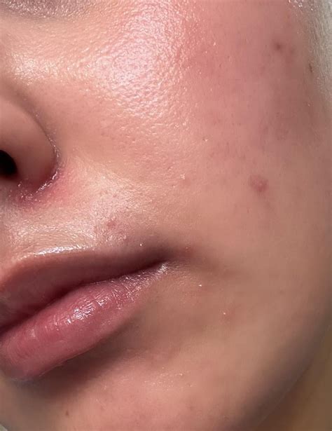 Staph Infection While On Accutane R Accutane