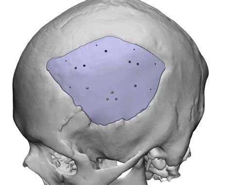 ArcomedLab Produced 700 3D Printed Cranial Implants