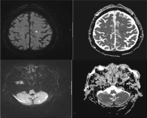 Brain Magnetic Resonance Imaging Axial Dwi Left And Adc Map Right