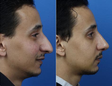 When To Choose A Nose Tip Surgery Over Full Rhinoplasty Philip Miller Md