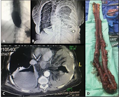 Laparoscopic Damage Control In Type Iv Paraesophageal Hiatal Hernia