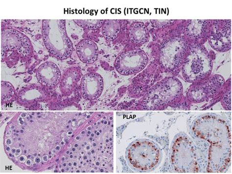 Figure 1 Histology Of Germ Cell Neoplasia Endotext Ncbi Bookshelf