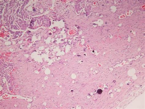 Case Summary 47세 여자 C.C.: hematochezia (내원 3일 전) Colonoscopy: - ppt ...