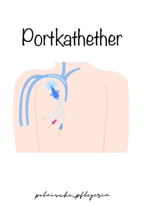 Tutorial Port Catheter - Etsy