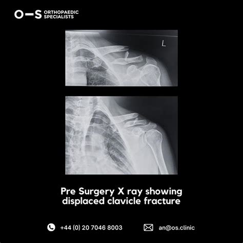 Clavicle Fracture Surgery - OS Clinic