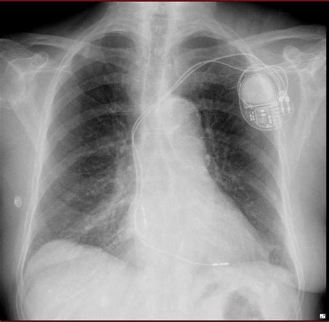 Right Atrial Pacing Site MicroPort Academy