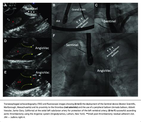 Transesophageal Echocardiography And Fluoroscopy During Ascending Download Scientific Diagram