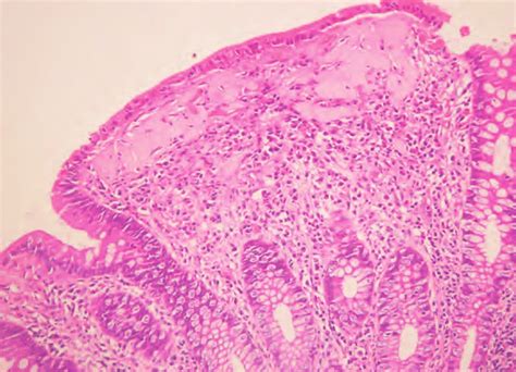 Collagenous Colitis Thickened Collagen Band Hande Staining Download Scientific Diagram