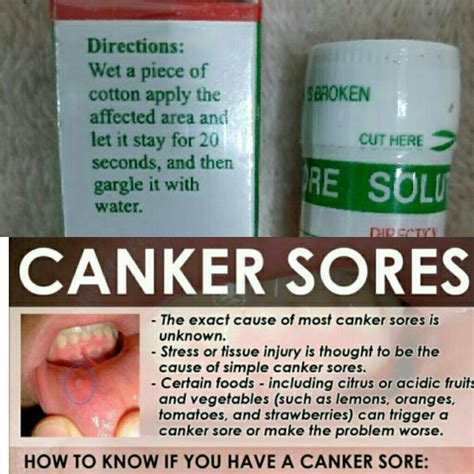 Business News Ph Canker Mouth Sore Solution Gamot Sa Singaw