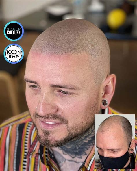 Does Scalp Micropigmentation Affect Hair Growth