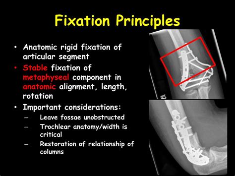 Ppt Surgical Management Of Intra Articular Distal Humerus Fractures Powerpoint Presentation