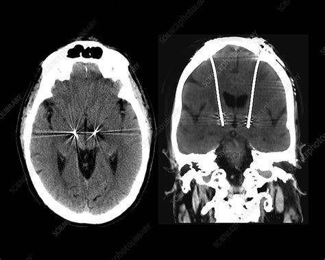 Parkinson's disease brain stimulation electrodes, CT scans - Stock ...