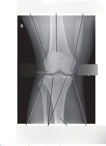 Ap Knee Diagram Quizlet