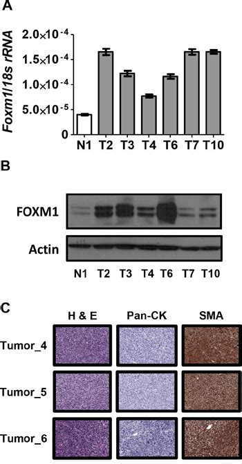 Genetic Determinants Of Foxm1 Overexpression In Epithelial Ovarian