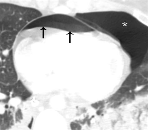 Multidetector Ct Of Blunt Thoracic Trauma Radiographics