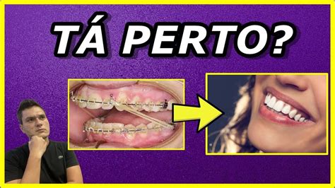 Depois De Tirar O Aparelho Os Dentes Voltam