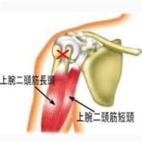 肩や二の腕の痛みの原因は？上腕二頭筋長頭腱炎の症状・対処法を解説！ Style Up Gym Charisfitのブログ