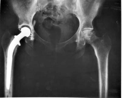 Hip Replacement Recovery Time Iytmed