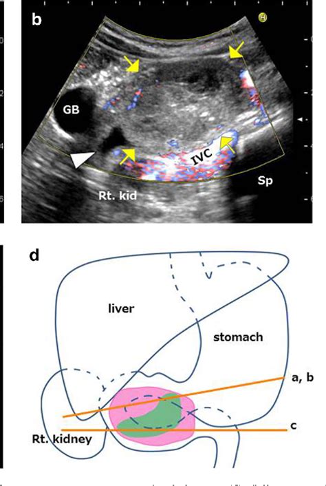 Ultrasound Follow Up In A Patient With Intestinal Obstruction Due To