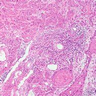 Histopathology Shows Nests And Sheets Of Tumor Cells Showing Nuclear