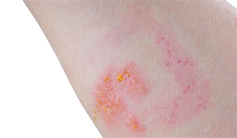 6 Home Remedies For Treating Skin Rashes