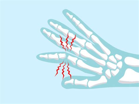 Phalanx Fracture: Types, Symptoms, Causes & Treatment