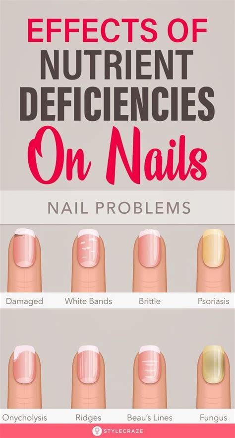 8 Important Signs Your Fingernails Can Tell About Your Health Nail